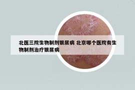 北醫(yī)三院生物制劑銀屑病 北京哪個醫(yī)院有生物制劑治療銀屑病