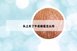 頭上長了牛皮癬是怎么樣