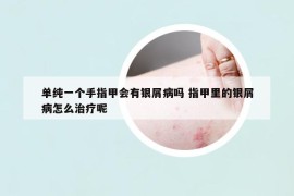 單純一個手指甲會有銀屑病嗎 指甲里的銀屑病怎么治療呢