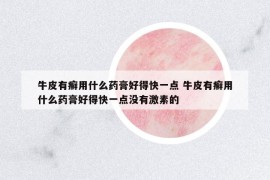 牛皮有癬用什么藥膏好得快一點 牛皮有癬用什么藥膏好得快一點沒有激素的