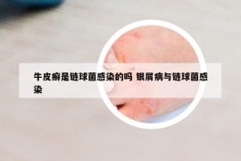 牛皮癬是鏈球菌感染的嗎 銀屑病與鏈球菌感染