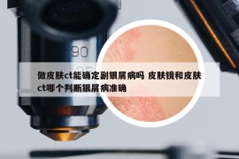 做皮膚ct能確定副銀屑病嗎 皮膚鏡和皮膚ct哪個(gè)判斷銀屑病準(zhǔn)確