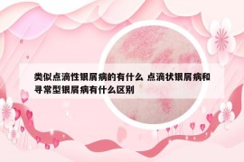 類似點滴性銀屑病的有什么 點滴狀銀屑病和尋常型銀屑病有什么區(qū)別