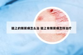 腿上的銀屑病怎么治 腿上有銀屑病怎樣治療