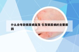 什么會(huì)導(dǎo)致銀屑病復(fù)發(fā) 引發(fā)銀屑病的主要原因