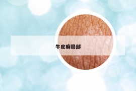 牛皮癬局部