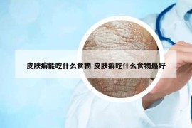 皮膚癬能吃什么食物 皮膚癬吃什么食物最好
