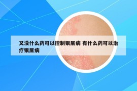又沒什么藥可以控制銀屑病 有什么藥可以治療銀屑病