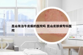 昆山有治牛皮癬的醫(yī)院嗎 昆山皮膚病?？漆t(yī)院