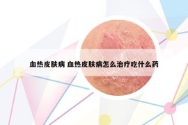 血熱皮膚病 血熱皮膚病怎么治療吃什么藥
