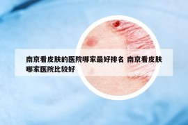 南京看皮膚的醫(yī)院哪家最好排名 南京看皮膚哪家醫(yī)院比較好