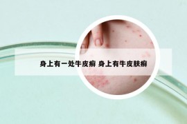 身上有一處牛皮癬 身上有牛皮膚癬