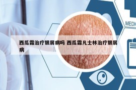 西瓜霜治療銀屑病嗎 西瓜霜凡士林治療銀屑病
