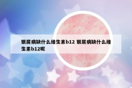 銀屑病缺什么維生素b12 銀屑病缺什么維生素b12呢