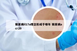 銀屑病il17a理念形成于哪年 銀屑病acr20