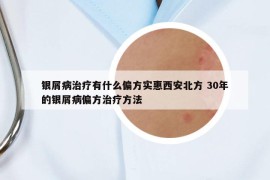 銀屑病治療有什么偏方實(shí)惠西安北方 30年的銀屑病偏方治療方法