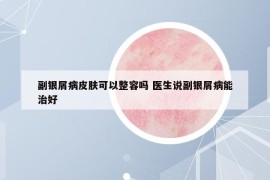 副銀屑病皮膚可以整容嗎 醫(yī)生說副銀屑病能治好