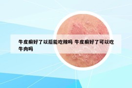 牛皮癬好了以后能吃辣嗎 牛皮癬好了可以吃牛肉嗎