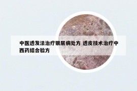 中醫(yī)透發(fā)法治療銀屑病處方 透皮技術(shù)治療中西藥結(jié)合驗(yàn)方