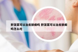 野菠菜可以治皮膚癬嗎 野菠菜可以治皮膚癬嗎怎么吃