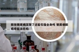 膿包銀屑病又飯了還能引指全身嗎 銀屑病膿皰疹能治愈嗎
