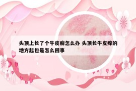 頭頂上長了個牛皮癬怎么辦 頭頂長牛皮癢的地方起包是怎么回事