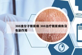 308準(zhǔn)分子銀屑病 308治療銀屑病有沒有副作用