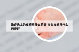 治療頭上的皮癬用什么藥膏 治頭皮癬用什么藥膏好