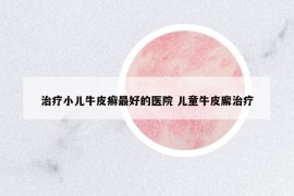 治療小兒牛皮癬最好的醫(yī)院 兒童牛皮廨治療