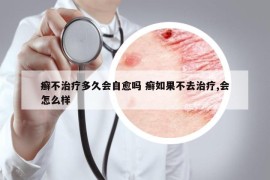 癬不治療多久會(huì)自愈嗎 癬如果不去治療,會(huì)怎么樣