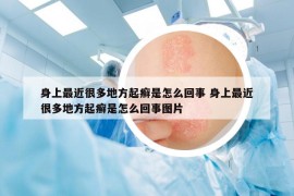 身上最近很多地方起癬是怎么回事 身上最近很多地方起癬是怎么回事圖片