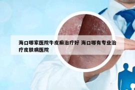 ?？谀募裔t(yī)院牛皮癬治療好 海口哪有專業(yè)治療皮膚病醫(yī)院