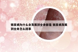 銀屑病為什么會(huì)發(fā)展到全身都是 銀屑病發(fā)展到全身怎么回事
