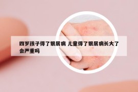 四歲孩子得了銀屑病 兒童得了銀屑病長大了會嚴重嗎