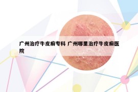 廣州治療牛皮癬?？?廣州哪里治療牛皮癬醫(yī)院