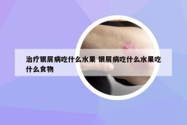 治療銀屑病吃什么水果 銀屑病吃什么水果吃什么食物