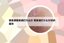 銀屑病銀屑病打什么針 銀屑病打什么針好的最快