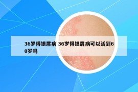 36歲得銀屑病 36歲得銀屑病可以活到60歲嗎