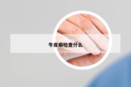 牛皮癬檢查什么