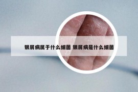 銀屑病屬于什么細(xì)菌 銀屑病是什么細(xì)菌