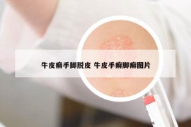 牛皮癬手腳脫皮 牛皮手癬腳癬圖片