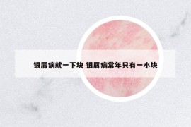 銀屑病就一下塊 銀屑病常年只有一小塊