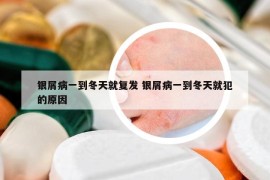 銀屑病一到冬天就復(fù)發(fā) 銀屑病一到冬天就犯的原因