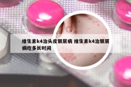 維生素k4治頭皮銀屑病 維生素k4治銀屑病吃多長時間