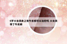 6歲小女孩身上有牛皮癬可以治好嗎 小女孩得了牛皮癬