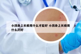 小孩身上長(zhǎng)癬用什么才能好 小孩身上長(zhǎng)癬用什么藥好