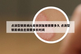 點滴型銀屑病從皮損到復(fù)原需要多久 點滴型銀屑病自愈需要多長時間