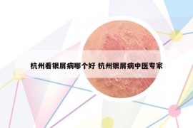 杭州看銀屑病哪個(gè)好 杭州銀屑病中醫(yī)專家