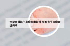 懷孕會引起牛皮癬能治好嗎 孕婦有牛皮癬會遺傳嗎