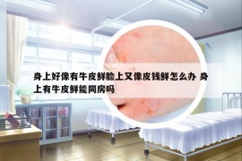 身上好像有牛皮鮮臉上又像皮錢鮮怎么辦 身上有牛皮鮮能同房嗎